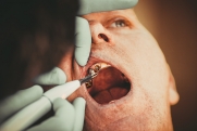 Стоматолог Ешидоржиев объяснил, почему после удаления зуба нужно ставить имплант