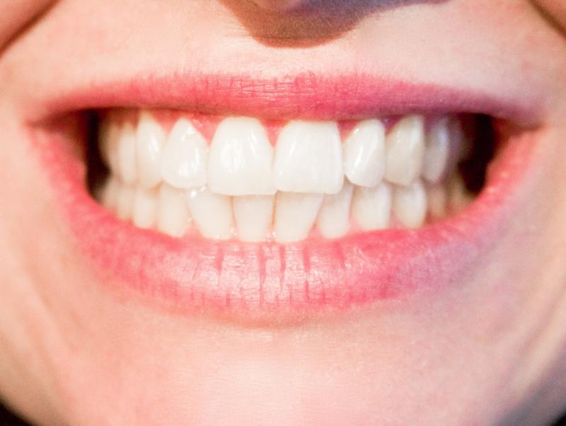 Ученые связали разрушение зубной эмали с потреблением газировки и лишним весом