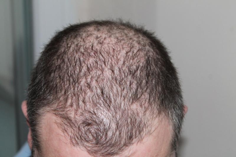 Коронавирус может вызвать выпадение волос